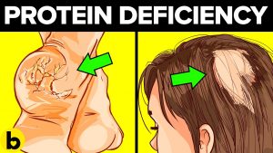 Read more about the article Signs You Have a Protein Deficiency